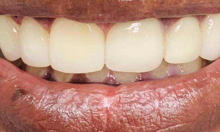 Porcelain-Crowns-After-Image