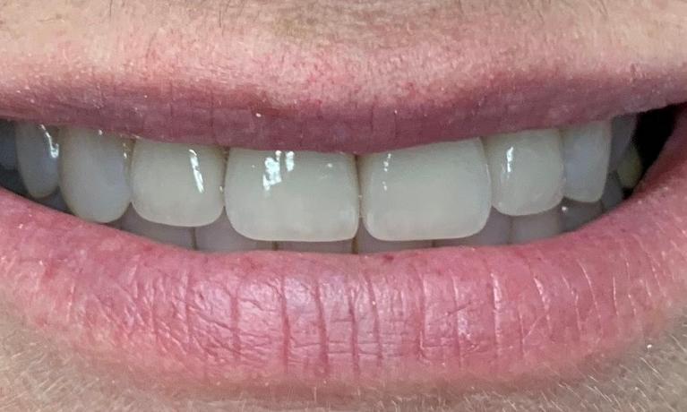 Porcelain-Crowns-and-In-Office-Whitening-After-Image