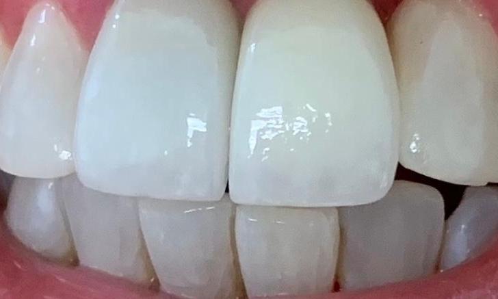 Dental-Implant-and-Porcelain-Crowns-After-Image