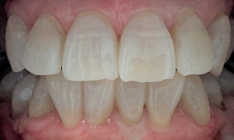 Tooth-Colored-Fillings-and-Teeth-Whitening-After-Image