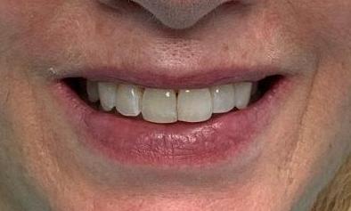 Invisalign-After-Image