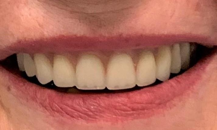 Implant-Supported-Denture-After-Image