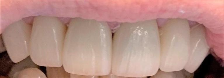 Tooth-Replacement-and-Cosmetic-Treatment-After-Image