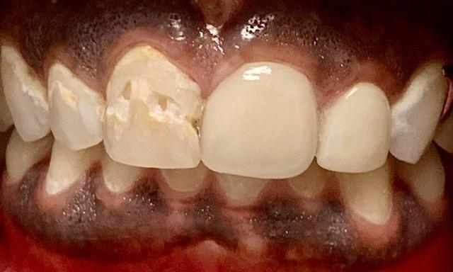Porcelain-Crowns-Before-Image