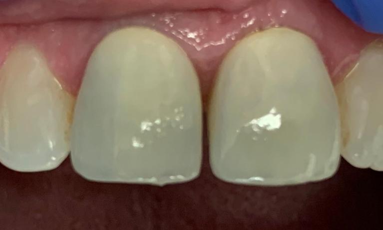 Porcelain-Crowns-and-In-Office-Whitening-Before-Image