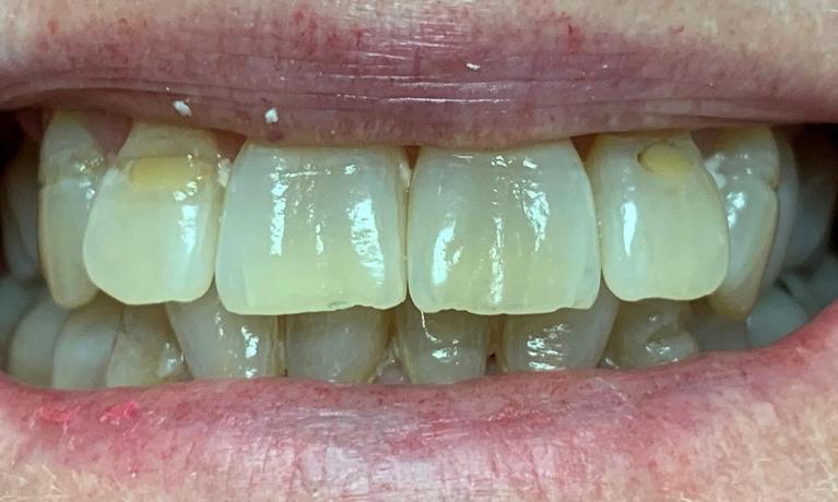 Tooth-Colored-Fillings-and-Teeth-Whitening-Before-Image
