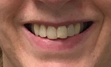 Invisalign-Before-Image