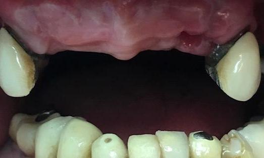 Implant-Supported-Denture-Before-Image