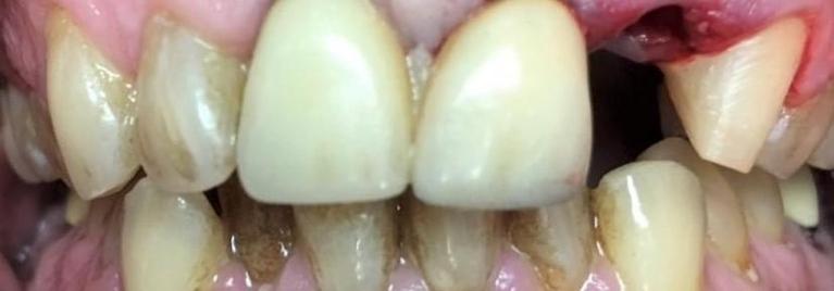 Tooth-Replacement-and-Cosmetic-Treatment-Before-Image
